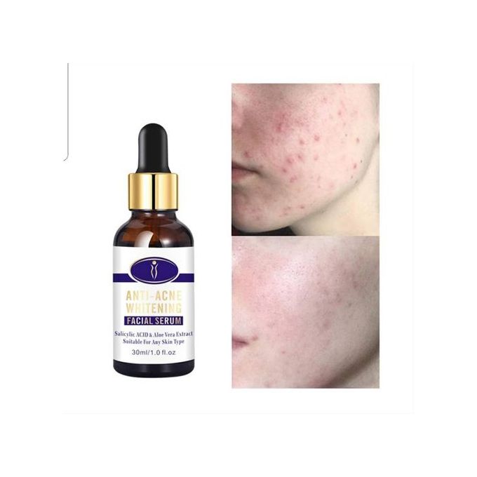Aichun Beauty Medical Formula Anti-Acne Whitening Facial Serum-30M