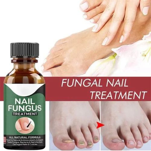 Fast Nail Fungus Treatment Serum – Nail Repair Essence for Finger & Toenail Care (All-Natural Formula)